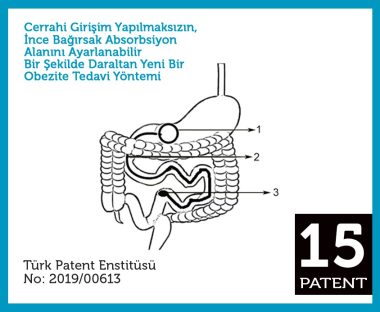 Cerrahi Girişim Yapılmaksızın, İnce Bağırsak Absorbsiyon Alanını Ayarlanabilir Bir Şekilde Daraltan Yeni Bir Obezite Tedavi Yöntemi