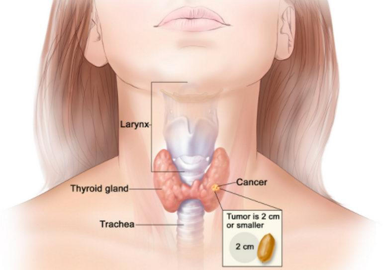 tiroid kanseri